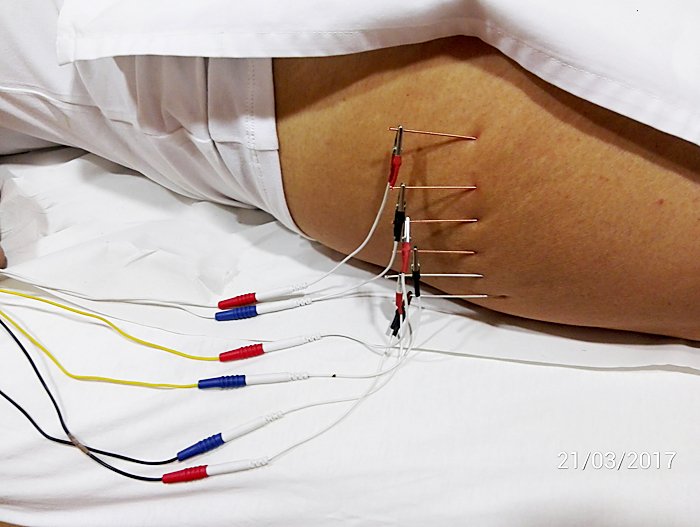 Electrolipolisis